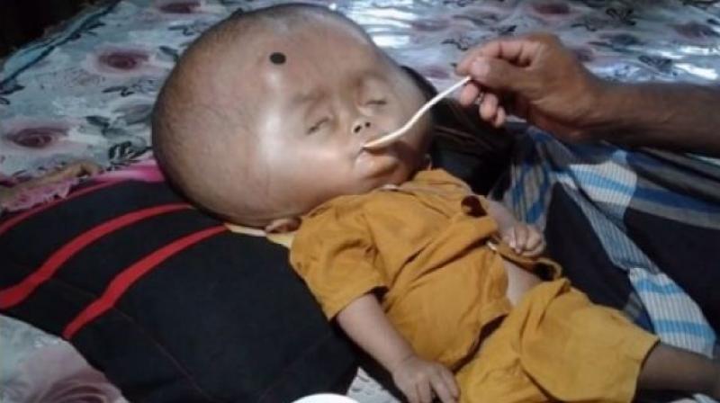 Bangladesh baby Emon suffered the same condition. (Photo: Youtube)