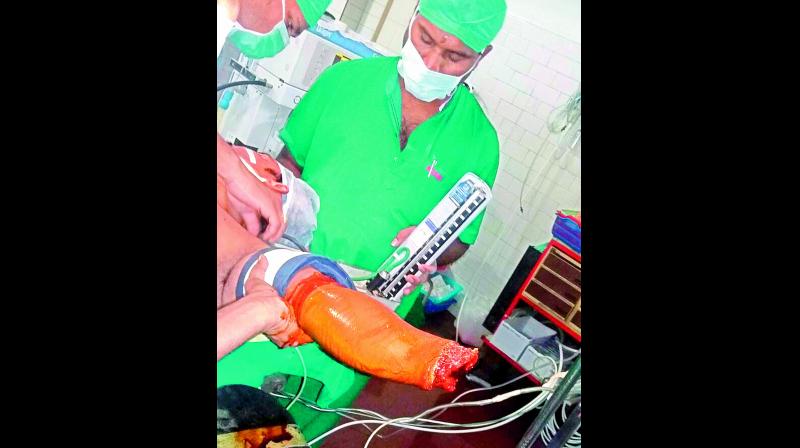Doctors perform a rare operation joining the hand which was cut down at wrist to the arm of G. Ravi at Lalitha Super Speciality Hospital in Guntur.