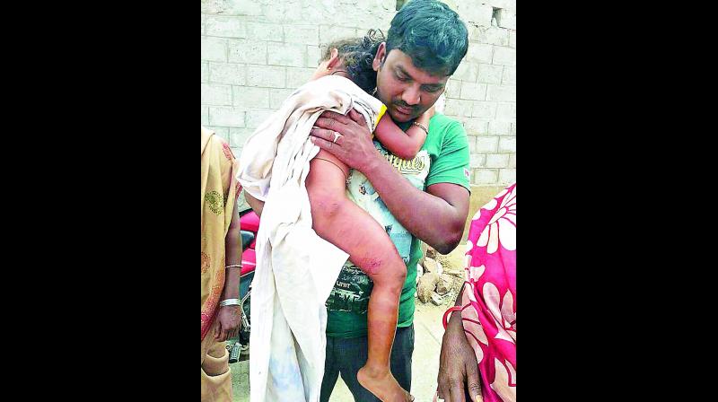 Kunchala Sravani, who was injured in a stray pig attack at Pedagantyada near Gajuwaka in Visakhapatnam on Tuesday.