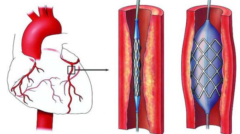 The stent price cap was on the agenda of the talks between Prime Minister Narendra Modi and US President Donald Trump after Members of the US Congress earlier signed a letter protesting Indias decision to cap the price of coronary stents.
