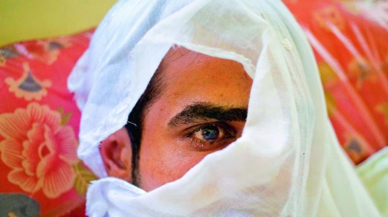 A youth whose eye was damaged after forces fired pellets at him in Srinagar.