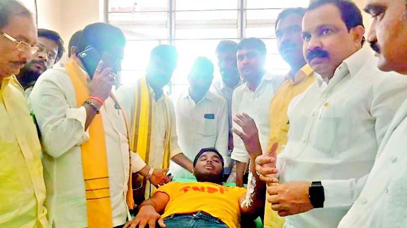 TD activist S. Chaitanya receives treatment for the burns he suffered during the protest, in Guntur on Thursday. (DC)