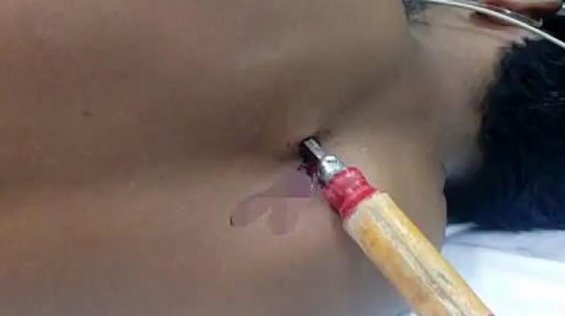 The doctors made three incisions to insert a camera inside (Photo: YouTube)