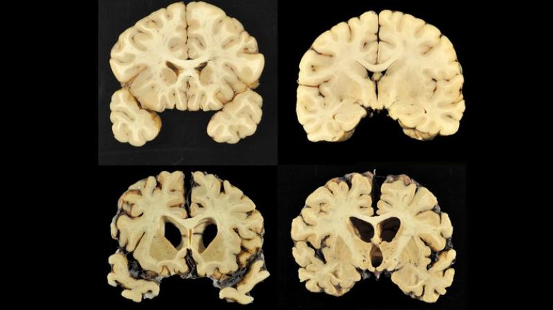 This combination of photos provided by Boston University shows sections from a normal brain, top, and from the brain of former University of Texas football player Greg Ploetz, bottom, in stage IV of chronic traumatic encephalopathy. (Photo: AP)