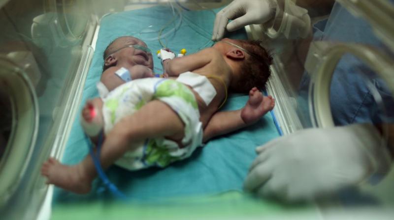 Conjoined twins who share key organs have a low chance of survival (Photo: AFP)