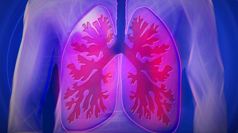 Lung cancer signs you need to be aware of. (Photo: Pixabay)