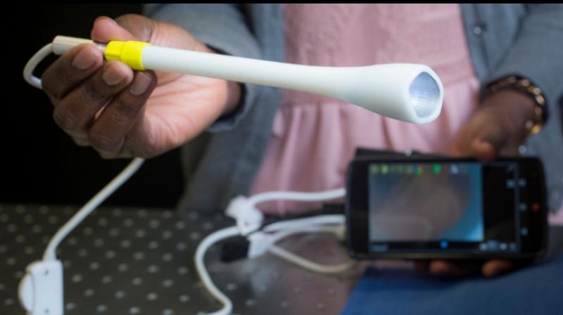 A prototype of the speculum-free â€œpocket colposcopeâ€ being developed by Duke University produces images on a smart phone or laptop and can make cervical cancer screening more accessible to women living in low-resource areas. (Photo: Duke University)