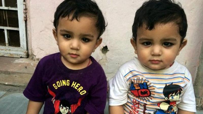 These Delhi twins were conceived as monoamniotic twins (sharing the same amniotic sac within the uterus), which entails high-risk pregnancy. (Photo: AP)