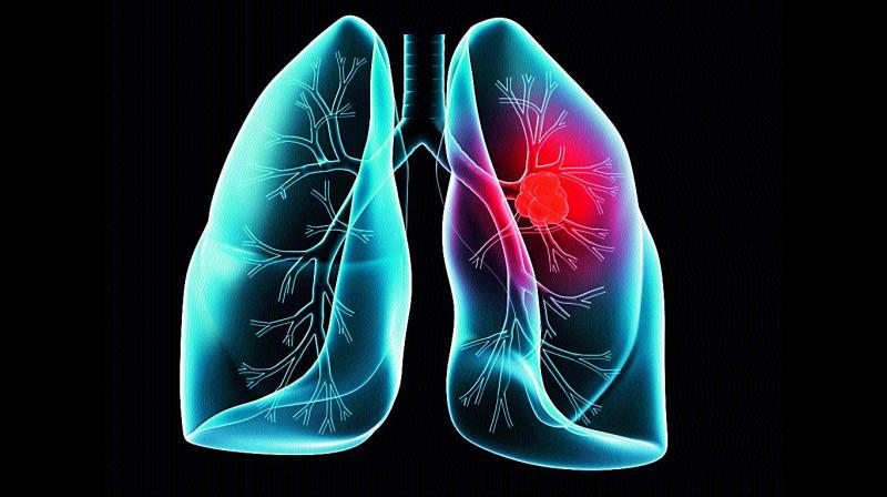 Since lung cancer is diagnosed mostly at the fourth stage, chances of treatment and survival are minimum.