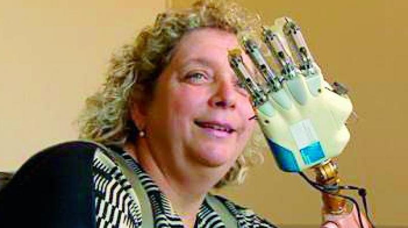 Woman gets robotic arm that can feel