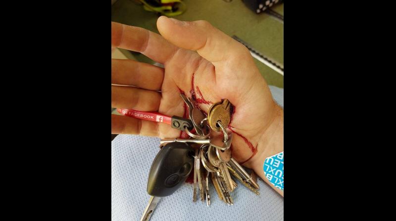 Electrician meets with horrific accident, has keys lodged into hands