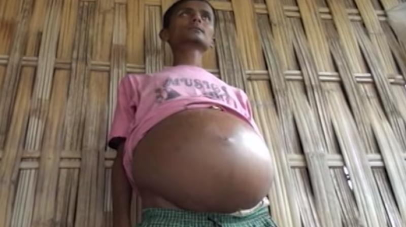 The family cant afford a surgery that can help Bikash (Photo: YouTube)