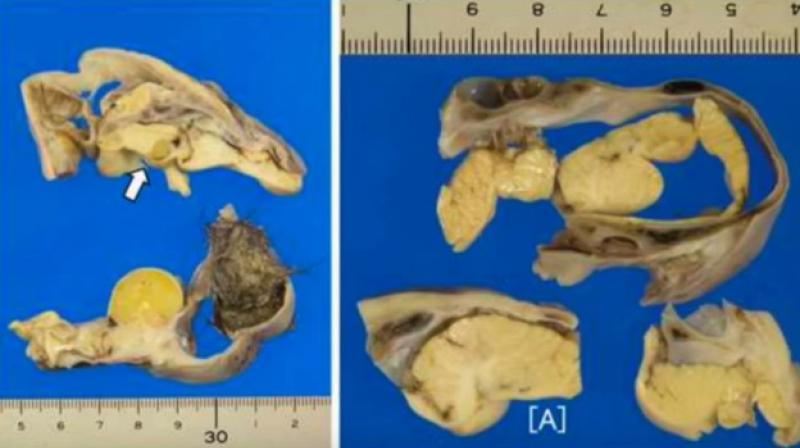 The tumour was about 10 centimetres wide and held a mat of greasy hair and a brain-like structure that was covered by skull-like bone material. (Credit: YouTube)