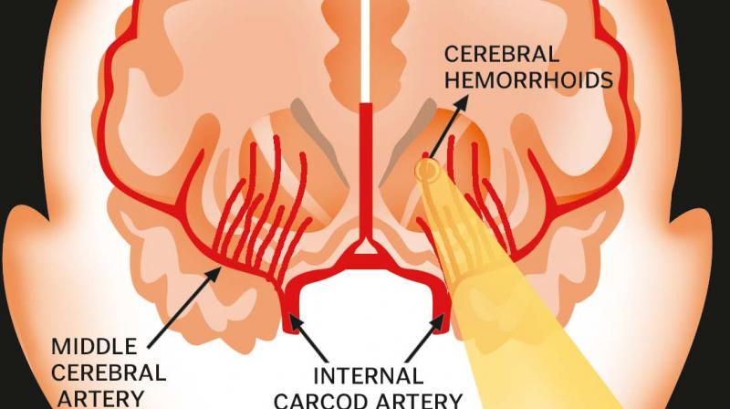 When a  person suffers a heart attack, they mostly get quite distinctive symptoms. However, the symptoms in the case of a stroke are silent. They  are sometimes  mistaken for temporary pains and ignored