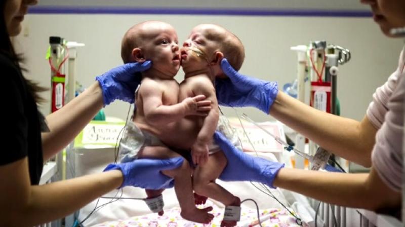 The girls are recovering and will take a month before they are finally able to go home for the first time (Photo: YouTube)