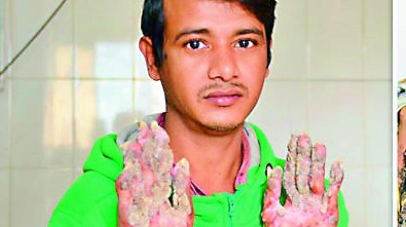 Abul Bajandar has had 25 surgeries since 2016 to remove the growths from his hands and feet at Dhaka Medical College Hospital.