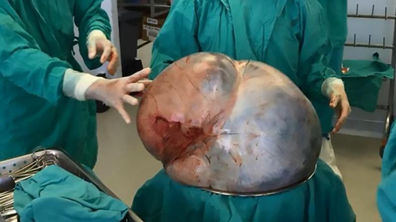 Such large tumours are common among women as compared to men since their bodies are designed to carry more weight in the abdomen (Photo: YouTube)