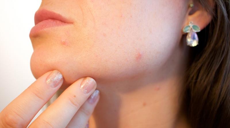 Scientists have found an antibody to a toxic protein that P. acnes bacteria secrete on skin - the protein is associated with the inflammation that leads to acne. (Photo: Pixabay)