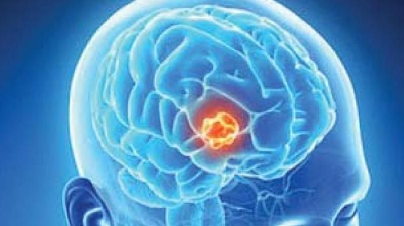 Nearly 80 to 100 cases of brain tumor are being reported at the Government General Hospital (GGH), Guntur, from rural areas every month.