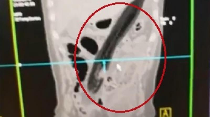X-ray revealed the shocking extent of the harm caused by the eggplant showing how it had reached all the way inside and damaged one of his lungs (Photo: YouTube)