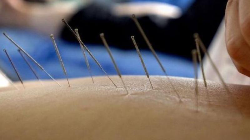 According to the traditional technique leaving needles in the skin can alleviate pain (Photo: AFP)