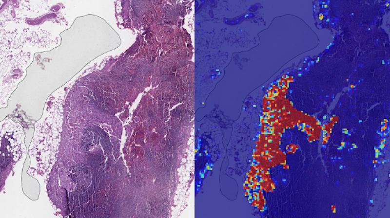 LYNA was able to accurately pinpoint the location of both cancers and other suspicious regions within each slide, some of which were too small to be consistently detected by pathologists.