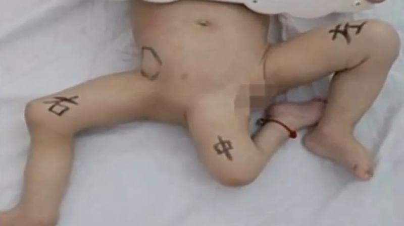 The baby was diagnosed with pygopagus parasiticus, a birth condition observed in one in a million pregnancies (Photo: YouTube)