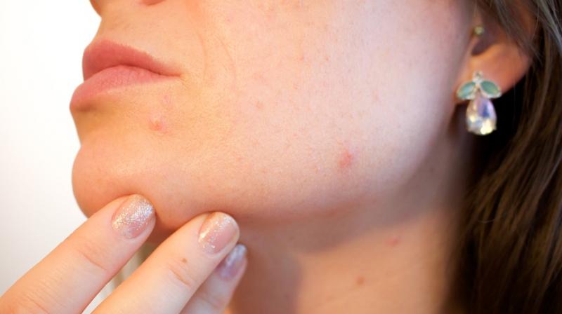 This drug could tackle acne. (Photo: Pixabay)