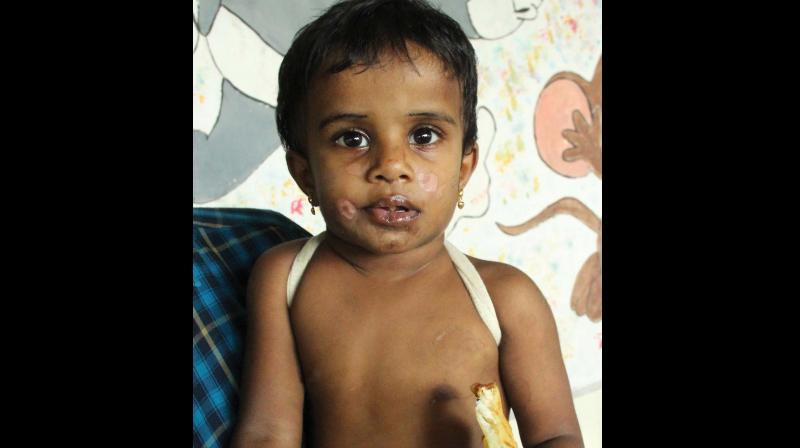 Two days ago, the girl was handed over to the family of Saira Banu who later handed her over to Anoop who noticed the scars and lodged a complaint with the police.