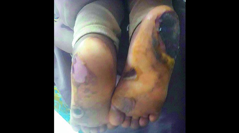 The burnt feet of a girl who was made to sit on a hot frying pan by her mother.