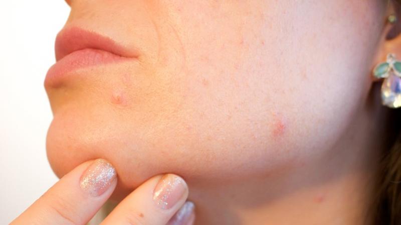 Acne includes whiteheads, blackheads, pimples, cysts and nodules that affect the face, shoulders, back, chest and upper arms.