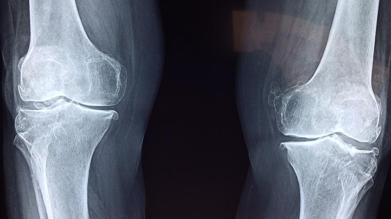 Many people with joint injuries would benefit from a good replacement for cartilage (Photo: Pixabay)