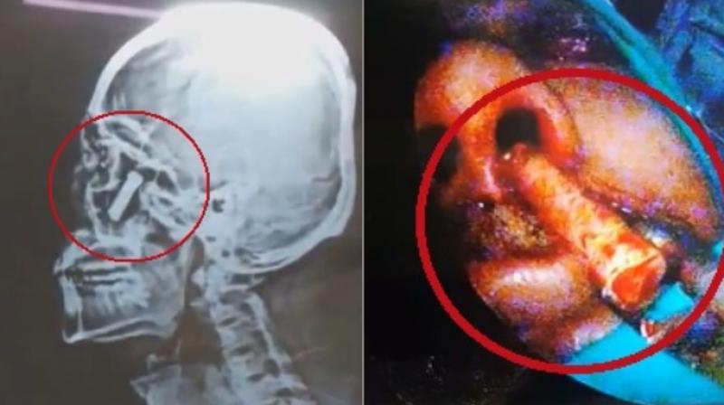 The bullet was pulled out without making a single incision on his face (Photo: YouTube)