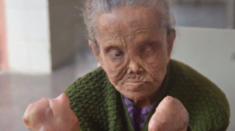 65-year-old Sajida Begum lost her fingers and toes (Photo: YouTube)