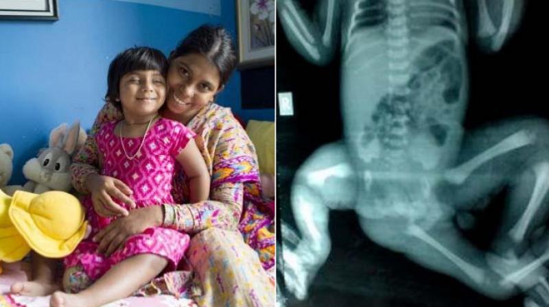 Bangladeshi girl with three legs can walk again after rare surgery