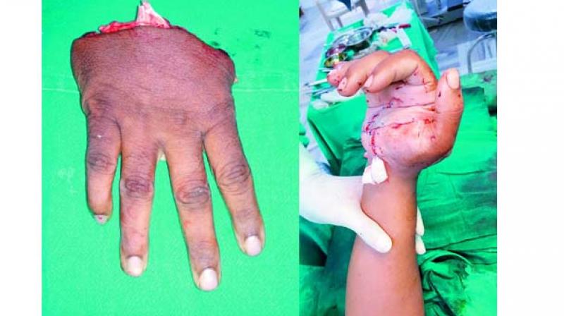 The cut (left) and the fixed wrist (right) of the Osmania University Press worker M. Chaturvedi. Co-workers had put the severed palm in a polythene bag and placed it in an ice box.