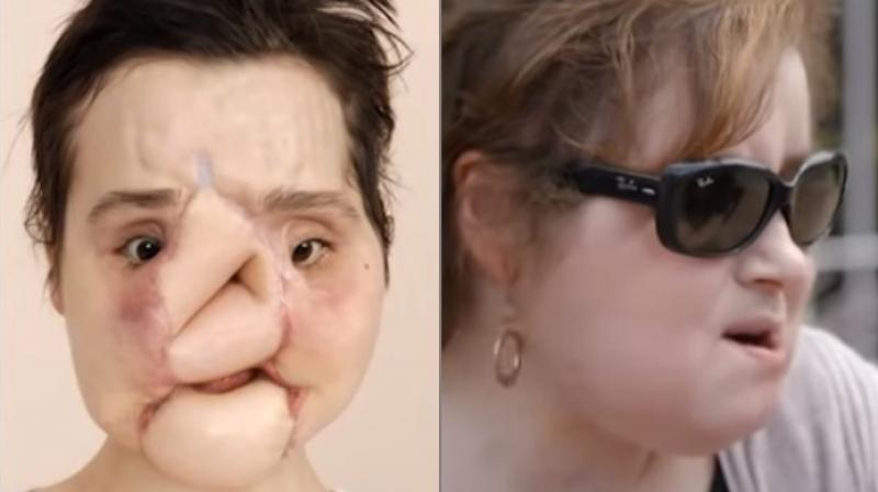 She will continue to be on medication for the rest of her life to minimize the risk of transplant rejection (Photo: YouTube)