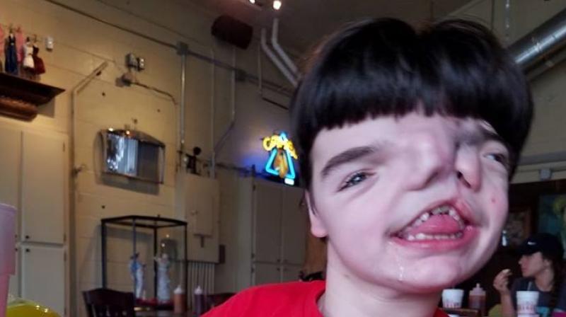 Cannabis oil that has helped him reduce the number of seizures from 400 to literally just 40 which is a big improvement. (Photo: Facebook)