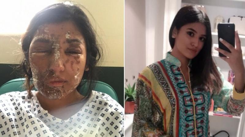 Resham Khan was attacked was acid by a stranger on her birthday. (Photo: Twitter - Reshkay / Go Fund Me)