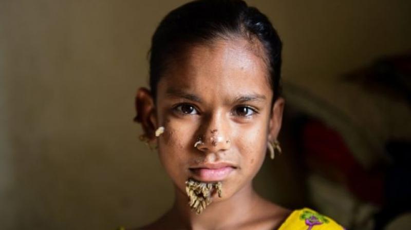 Shahana Khatun, 10, has bark-like warts growing out of her face. (Photo: AFP)