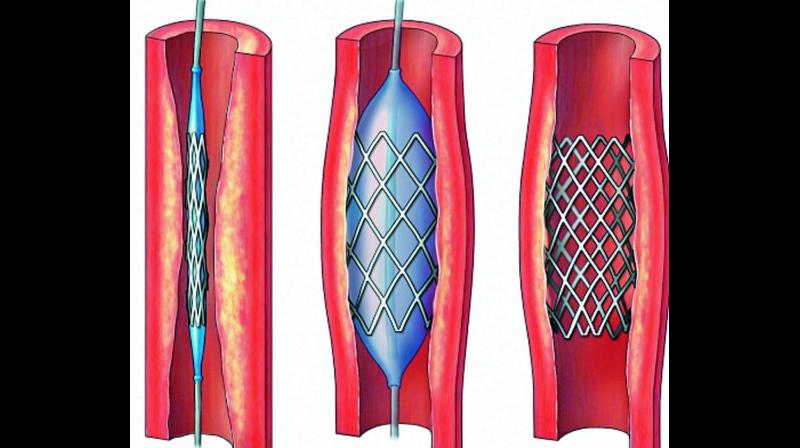 Drug Control official B. Suresh Babu appealed to public to contact ph no 0861-2331755 if any hospital charged them more than the price specified for coronary stents.