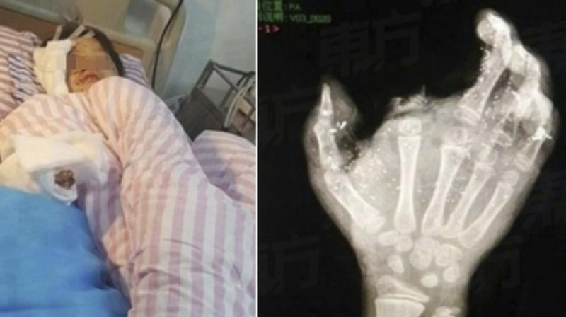 Meng Jisu from Guangxi province was charging the phone at home and when he leaned over the charger to reach for his phone, it exploded, blowing off his index finger immediately and left him unconscious.