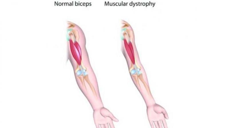 Muscular dystrophy