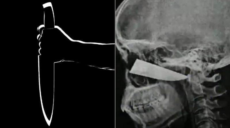 No blood vessels were damaged as the blade was surgically removed (Photo: YouTube/Pixabay)