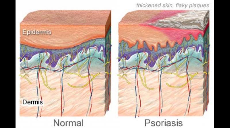 Though not a contagious or life threatening disease, psoriasis, a skin condition, has been found to be the cause of immense mental and physical stress for those affected by it.