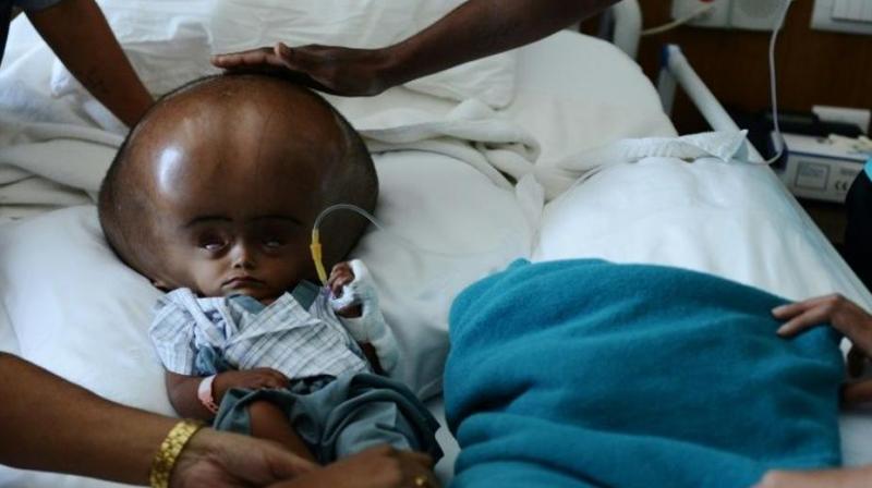 The five-year-old was born with hydrocephalus, a potentially fatal condition that causes cerebrospinal fluid to build up on the brain. (Photo: AFP)
