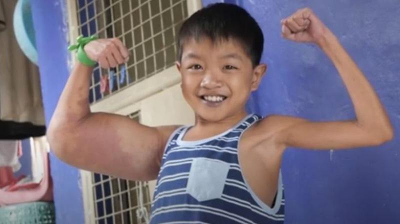 Daniels classmates at his school in Rizal, the Philippines, bullied him over the abnormal appearance but he hit back - telling them that he was like cartoon hero Popeye. (Photo: AP)