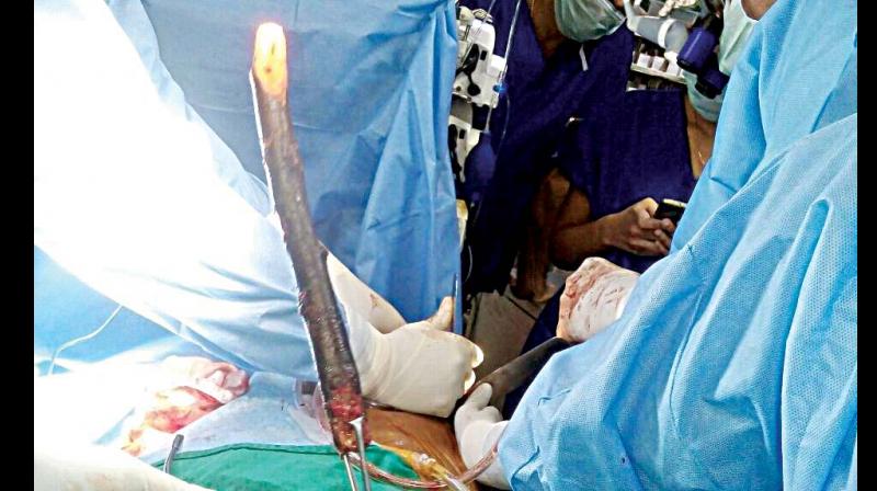 A piece of wood being removed from ASI Baburao Jagapaths chest  by doctors at the SDM Narayana Heart Centre in Dharwad.
