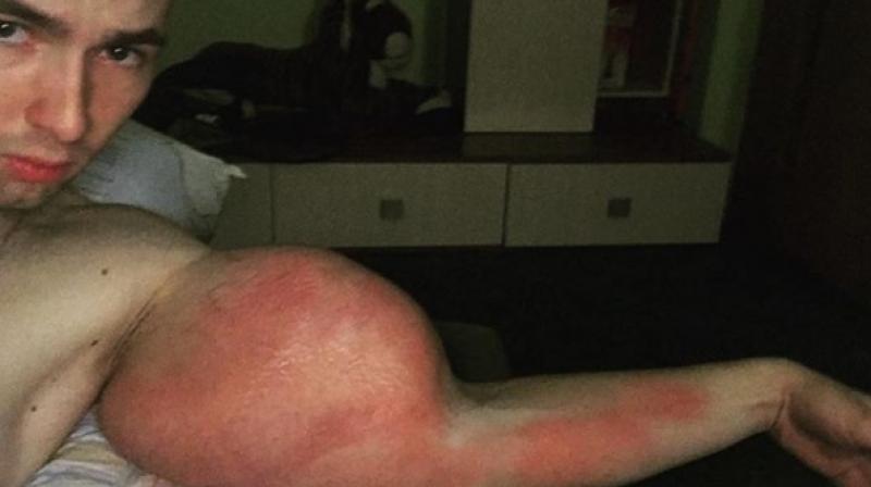 The chemicals have caused a disturbing red and purple discolouring (Photo: Instagram)