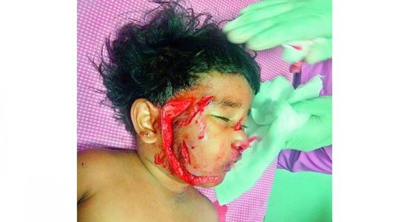 Bhavya  lies in a critical condition at Niloufer hospital after a pack of stray dogs attacked her.